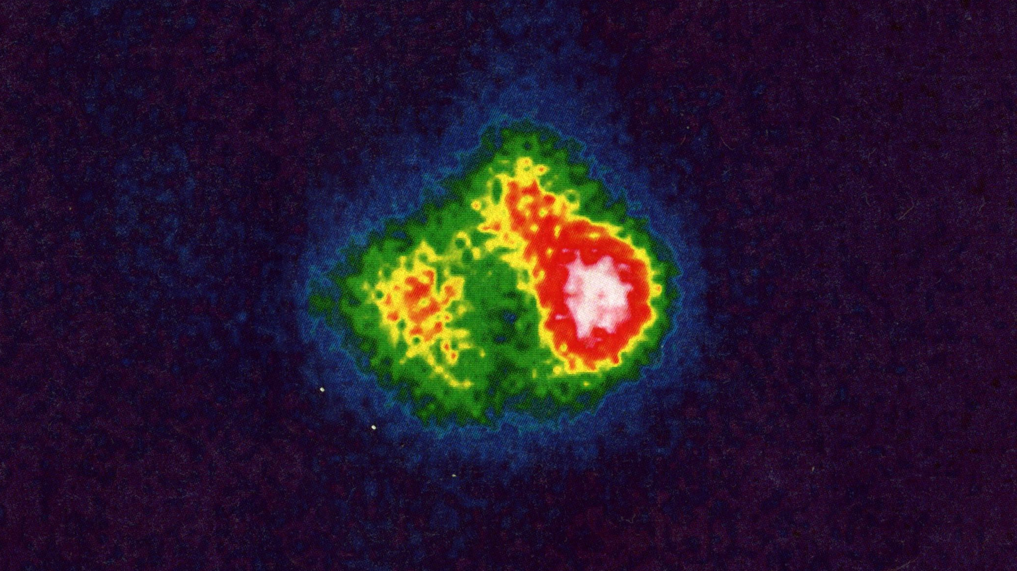 Fehldiagnose Hashimoto
