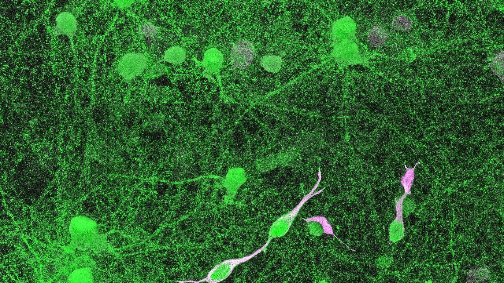 Nerven-Tumor-Netzwerk unter dem Mikroskop: In Magenta/Weiß markiert sind die Tumorzellen, in Grün die Nervenzellen, die direkt mit den Tumorzellen verbunden sind. Foto - Varun Venkataramani