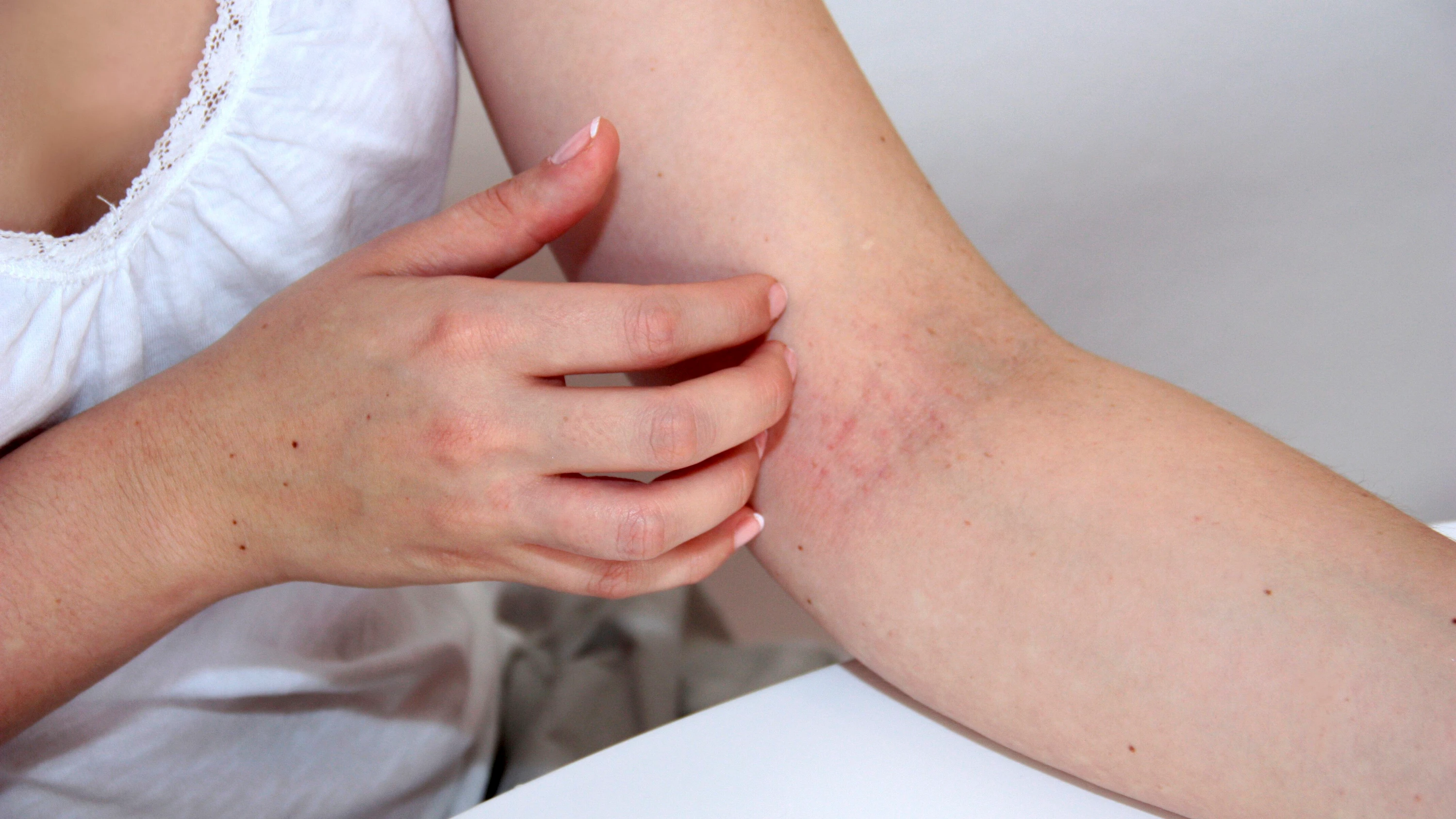 Neurodermitis: Was vor Schüben schützt