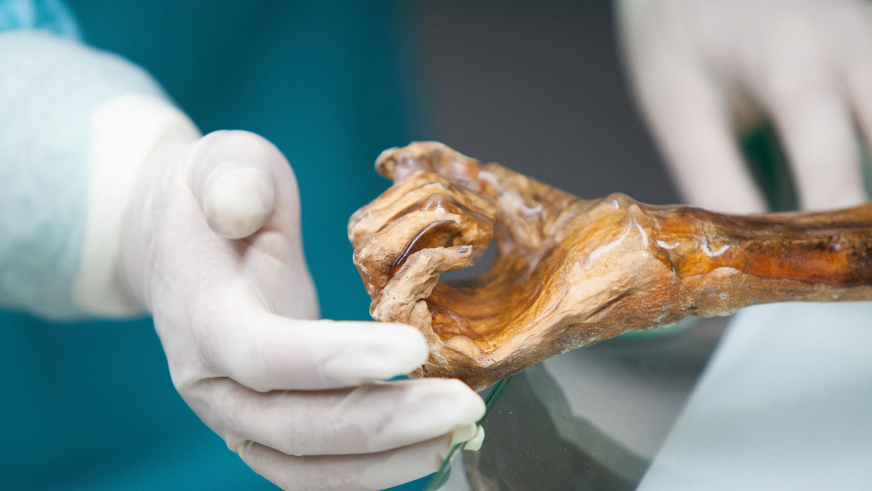 Paläopathologie: Hauptströmungen der Ötzi-Forschung
