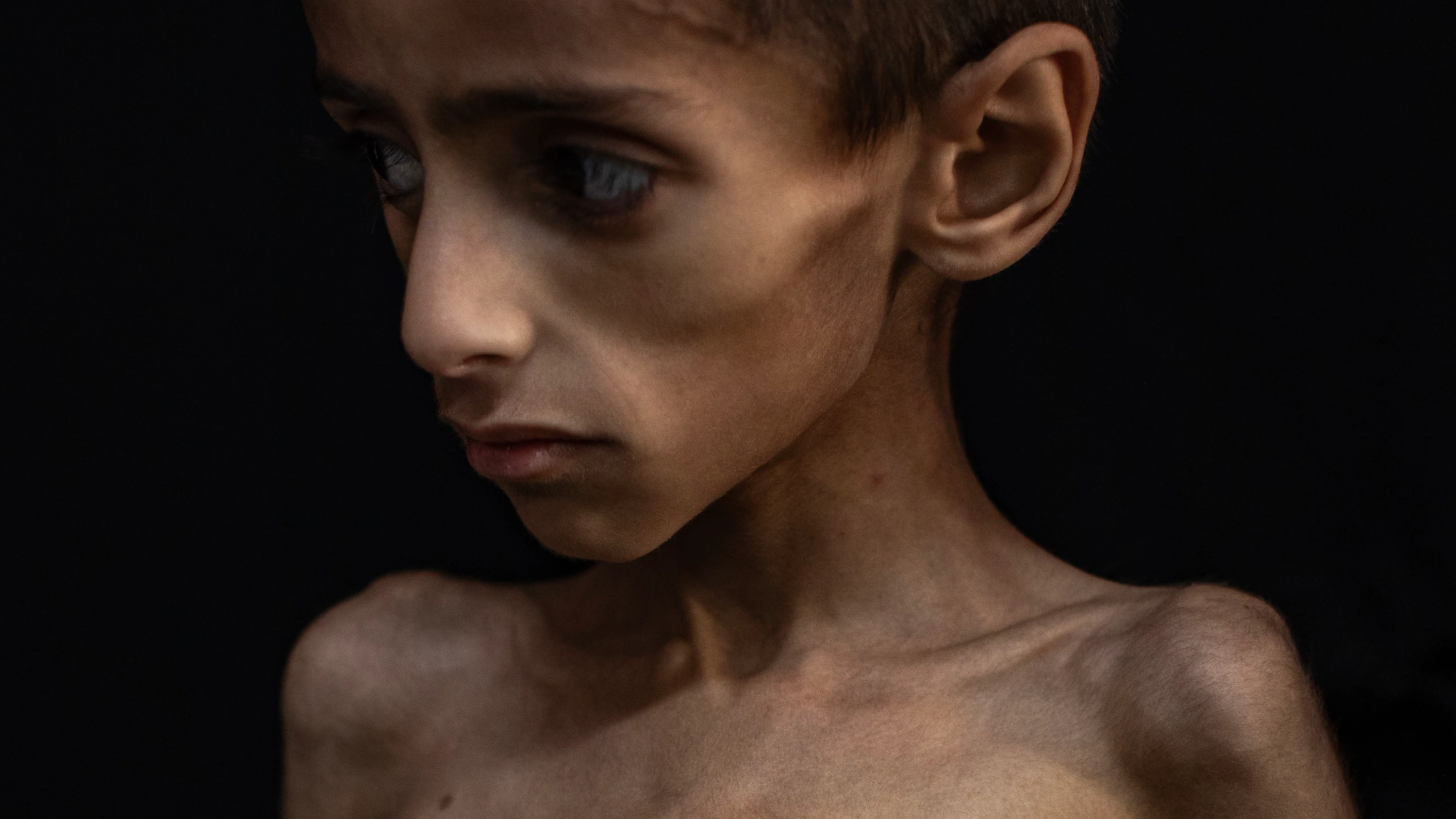 Sein Foto ging um die Welt: Osama al-Raqab wiegt jetzt 16 Kilogramm Sein Foto ging um die Welt: Osama al-Raqab wiegt jetzt 16 Kilogramm