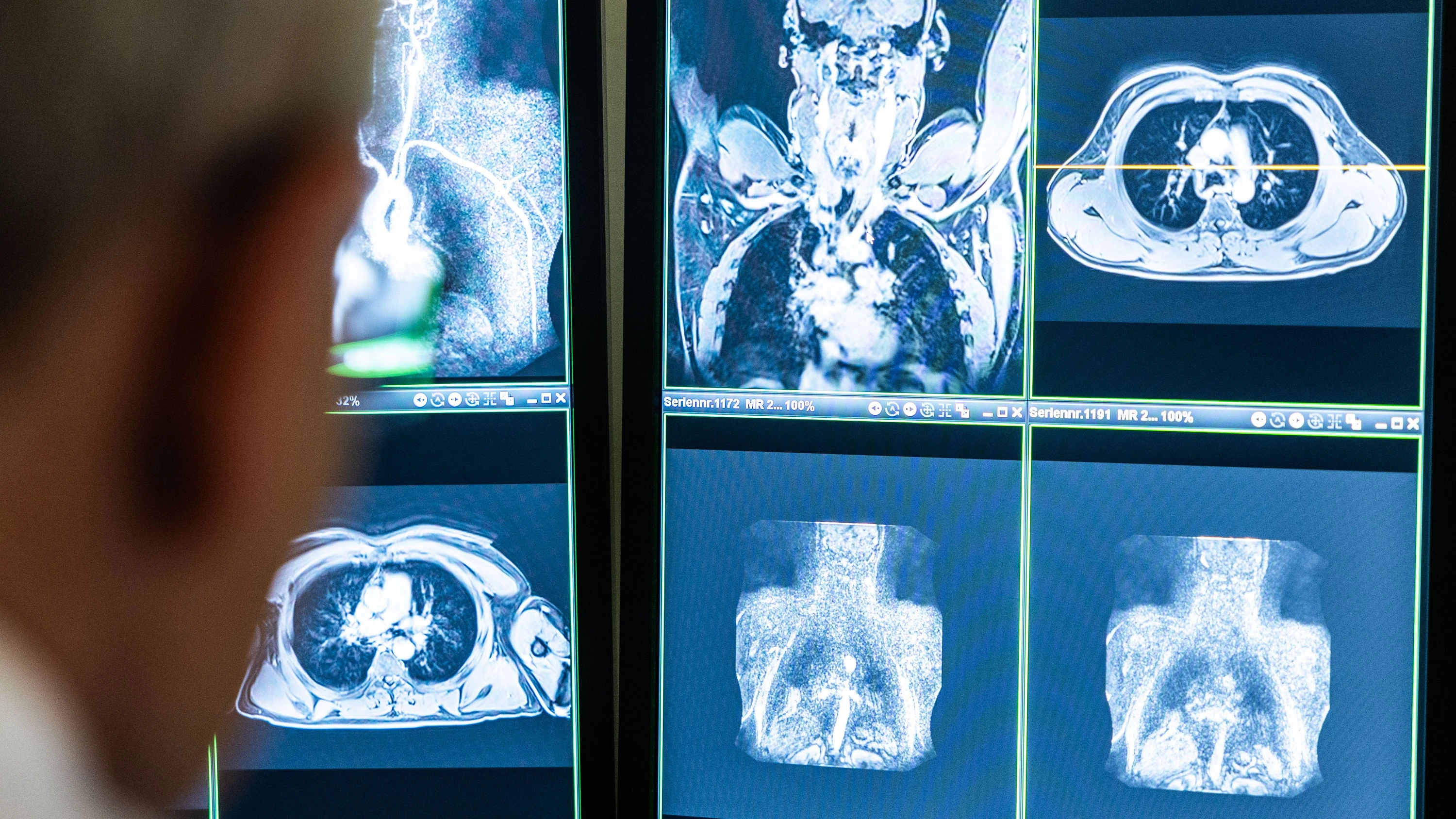 Symptome, Prognose, Therapie: Was man über Lungenkrebs wissen muss