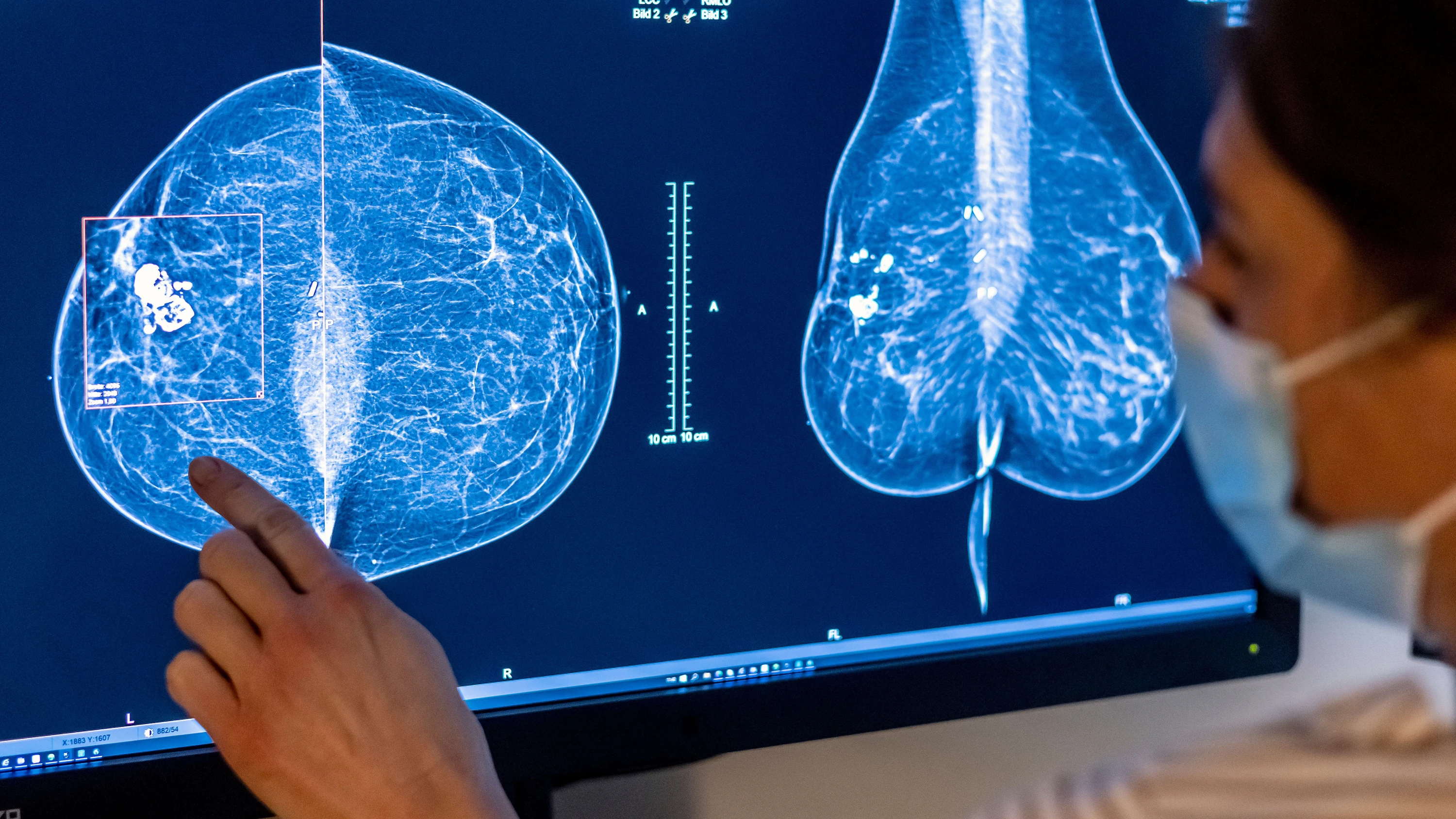 Internationale Studie: Was eine Immuntherapie bei Brustkrebs bringt