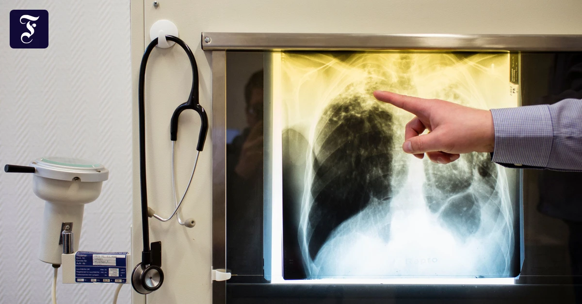 140-Kontaktpersonen-Zweiter-Tuberkulose-Fall-im-Landkreis-Bautzen