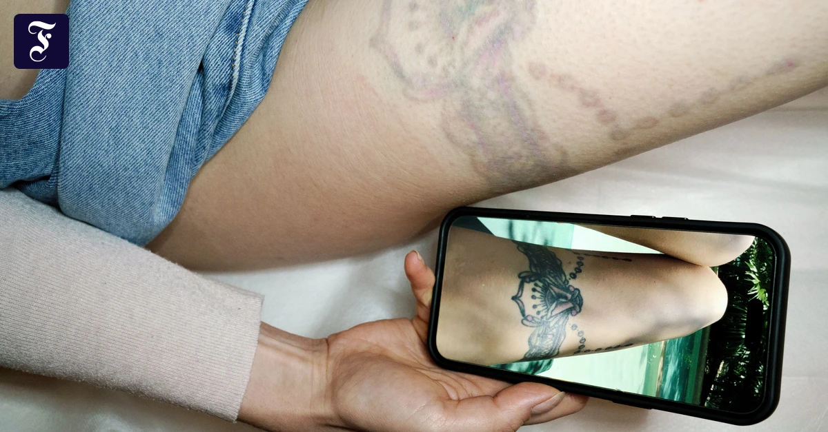 Tattoo-Entfernung-Wenn-das-Tattoo-wieder-weg-soll