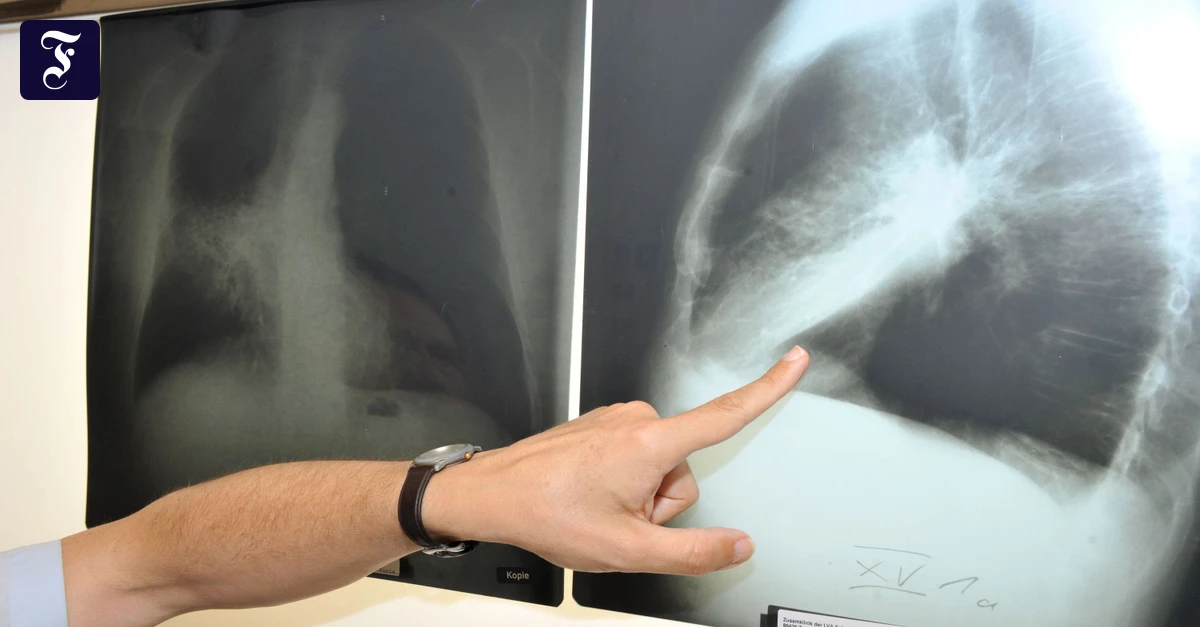 几乎每二个德国人就患有癌症 几乎每二个德国人就患有癌症