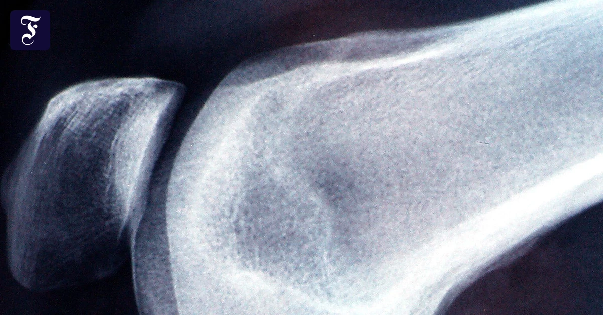 Neues-Gelenk-So-gut-kann-ein-neues-Knie-passen