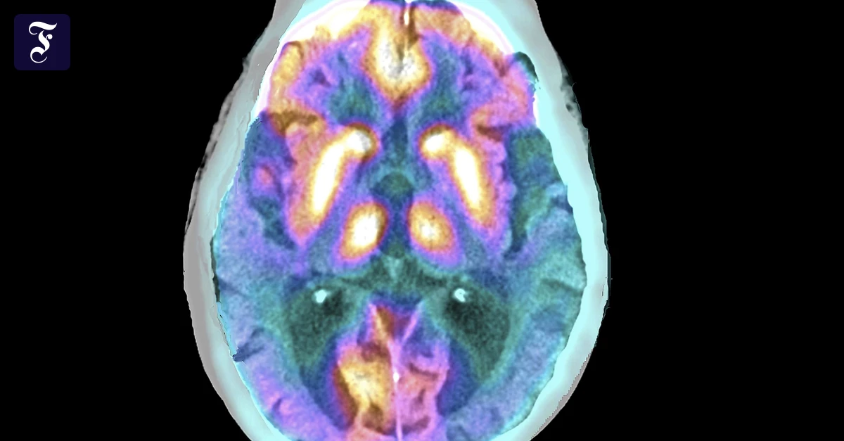 Demenz-Ist-die-neue-Alzheimertherapie-doch-nicht-so-gut-