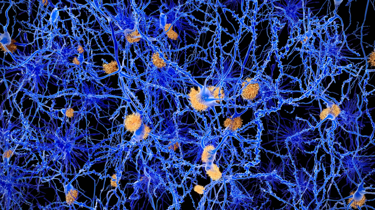 Computerillustration eines Alzheimer-Gehirns: Amyloid-Plaques werden nicht abtransportiert.