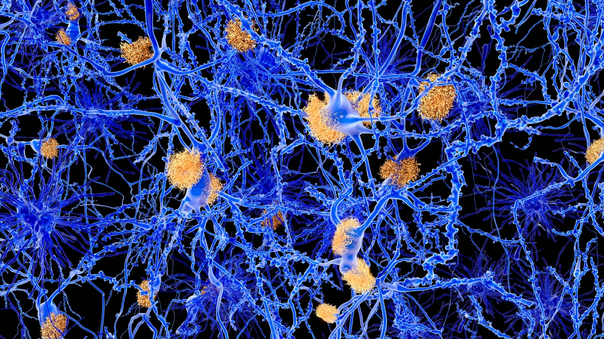Zwischen Nervenzellen lagert sich Amyloid (gelb) ab – aber ist das auch die Ursache von Alzheimer?