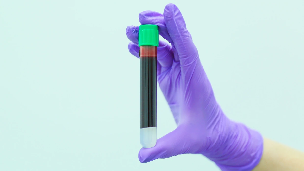 Besonders der im Blut gemessene Ferritinwert sagt etwas darüber aus, ob ein Eisenmangel vorliegt oder nicht.