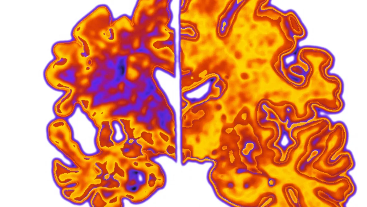Wie sich das Gehirn bei Alzheimer verändert, zeigt der linke Teil dieses Bildes. Rechts sieht man eine gesunde Hirnhälfte.
