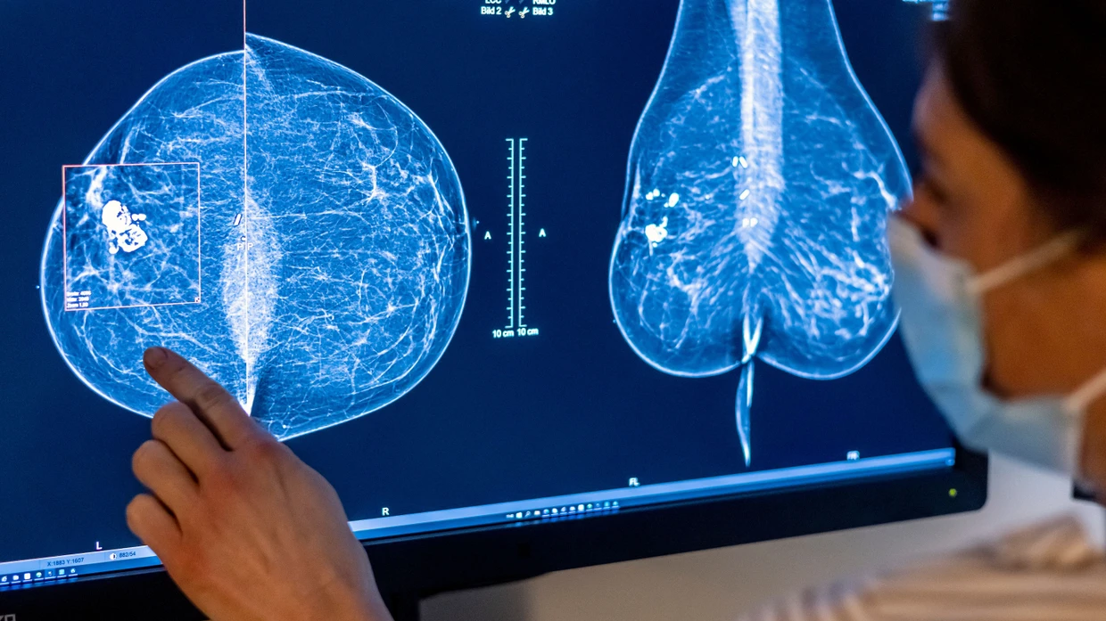 Wichtige Vorsorge: Mit Mammographie kann Brustkrebs erkannt werden.