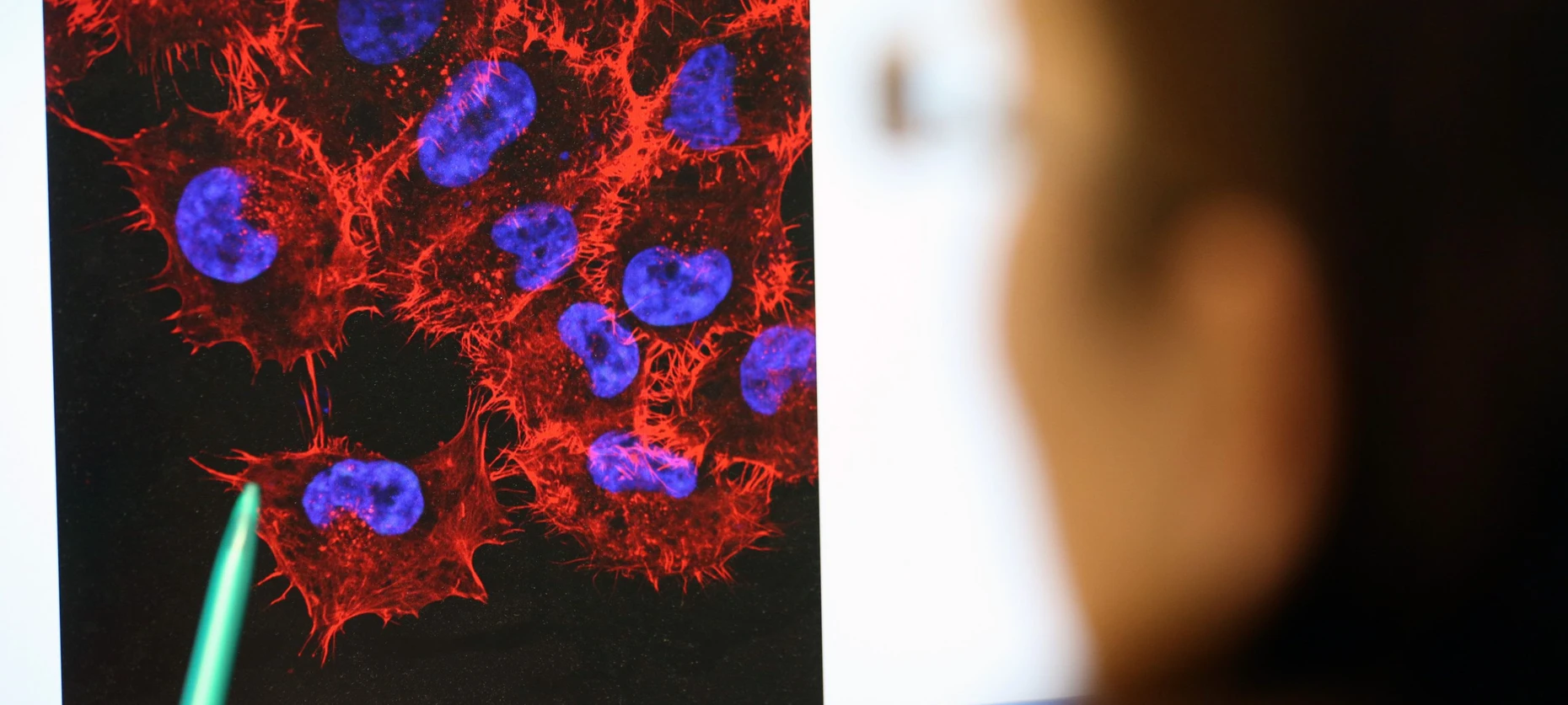 Erste mRNA-Impfung gegen Krebs besteht finale Studie