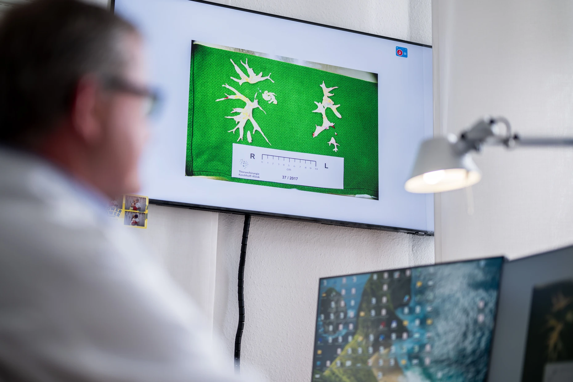 Gebilde auf dem Bildschirm: Guth zeigt aus Lungengefäßen von CTEPH-Patienten entferntes Narbenmaterial.