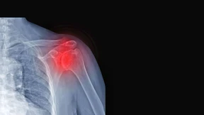 Rheuma ist keine Frage des Alters