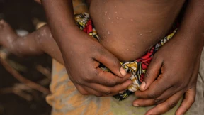 „Mpox ist nicht das neue Covid“