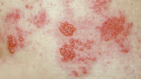 Biontech und Pfizer entwickeln Impfstoff gegen Gürtelrose