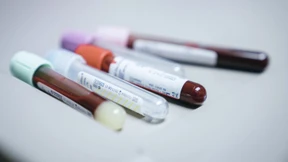 „Diabetes erhöht das Demenzrisiko“