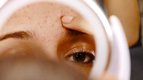 Ist Akne wirklich ein Problem?