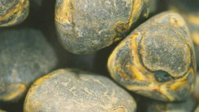 So groß ist die Gefahr von Gallensteinen