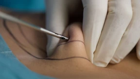 Krankenkassen übernehmen künftig Kosten für Liposuktion