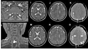 Was Long Covid mit dem Gehirn macht