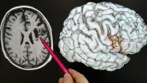 Zehntausend Schlaganfälle könnten verhindert werden