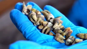 1000 menschliche Zähne in Wand gefunden