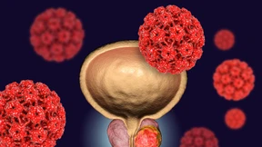 Prostatakrebs: Früh erkennen, besser behandeln