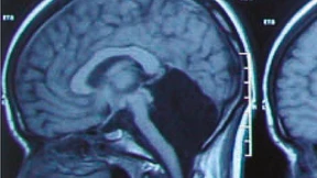 Die Frau ohne Kleinhirn