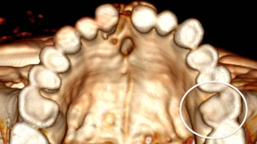 Der „Ötzi“ hatte schlechte Zähne