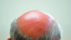 Krankenkassen müssen nicht für Haarwuchsmittel zahlen