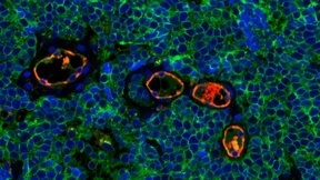 An welchen anderen Krankheiten Krebsüberlebende sterben