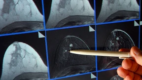 Diagnose Brustkrebs – Das ist neben klassischer Therapie wichtig