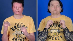 Mann erhält neues Gesicht und Hände