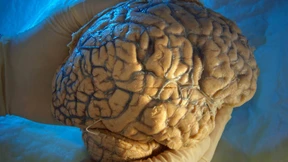 Alzheimer-Forscher wollen an die Börse