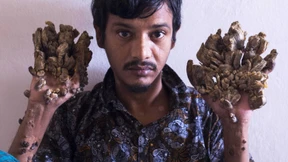 "Baummann" will sich Hände amputieren lassen