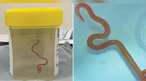 Wurm in Gehirn von Australierin entdeckt