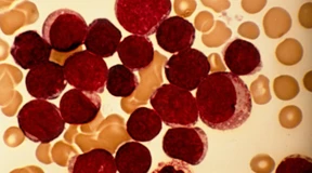 Neue Behandlung bei akuter lymphatischer Leukämie