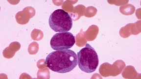 Neuer Wirkstoff gegen akute myeloische Leukämie entdeckt