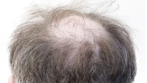 Medikament gegen Kreisrunden Haarausfall in den USA zugelassen