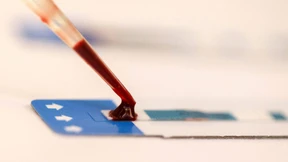 Zweiter Patient nach Behandlung frei von HIV 