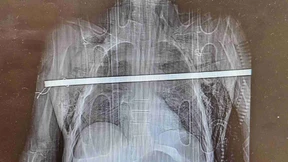 Mann spießt sich mit Eisenstange auf