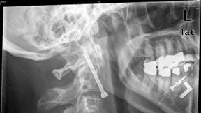 Eine Tablette gegen gebrochene Knochen?