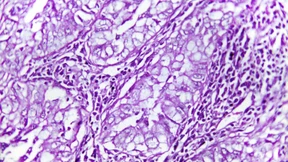 Mit Quantenoptik zu präziseren Krebsdiagnosen