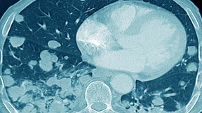 Kommt bald die Früherkennung für Lungenkrebs?