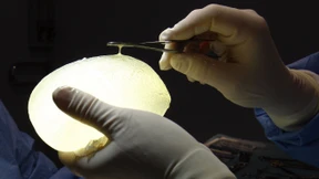 Seltene Krebsform bei Frauen mit Brustimplantat