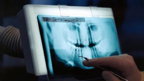 Warum Wurzelbehandlungen oft misslingen