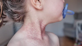 Neue Empfehlungen im Umgang mit Neurodermitis